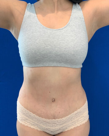 Tummy Tuck