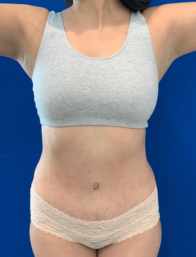 Tummy Tuck