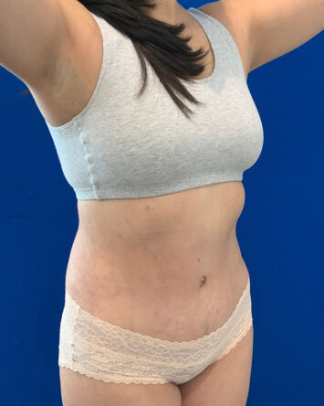 Tummy Tuck