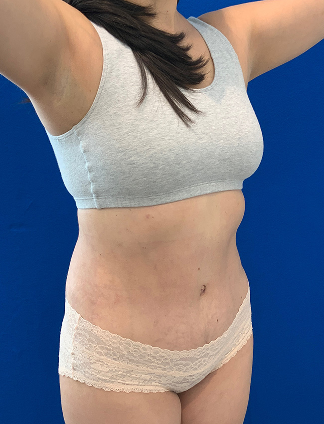 Tummy Tuck