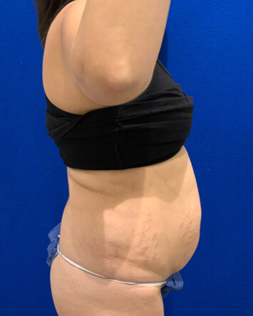 Tummy Tuck