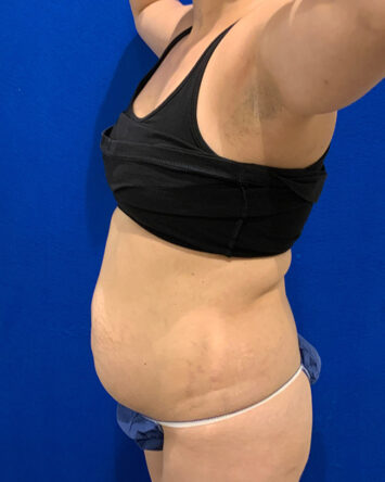 Tummy Tuck