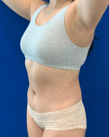 Tummy Tuck