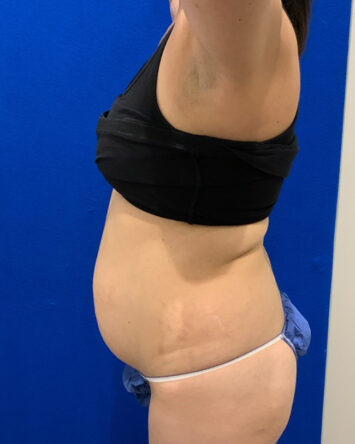 Tummy Tuck