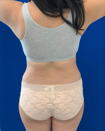 Tummy Tuck