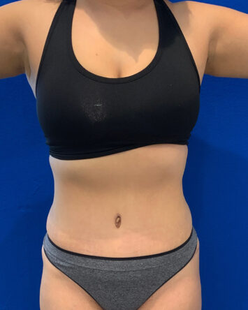 Tummy Tuck