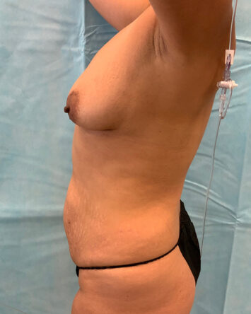 Tummy Tuck