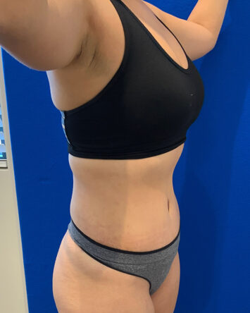 Tummy Tuck