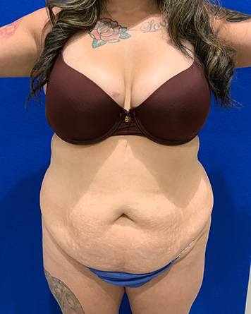 Tummy Tuck