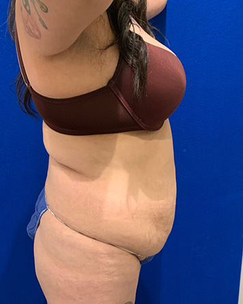 Tummy Tuck