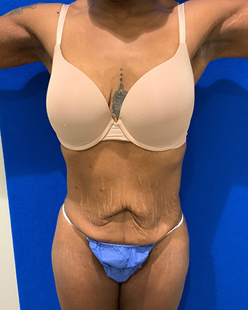 Tummy Tuck