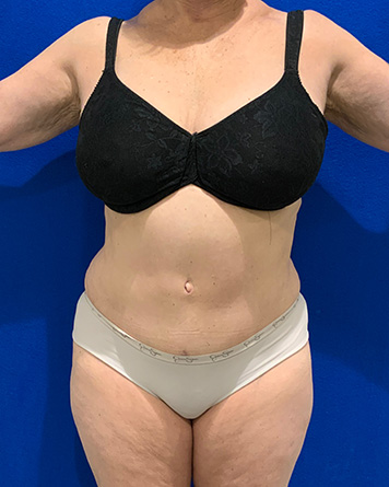 Tummy Tuck