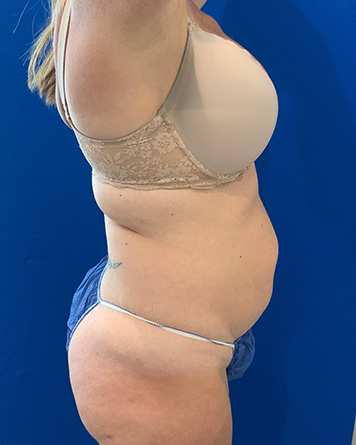 Tummy Tuck