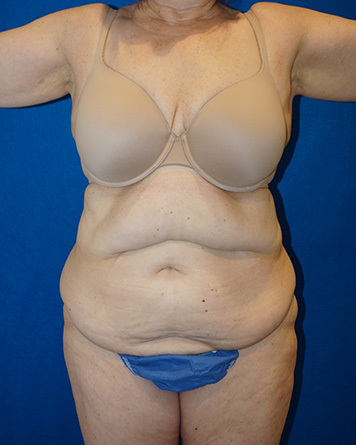 Tummy Tuck