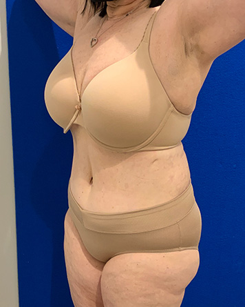 Tummy Tuck