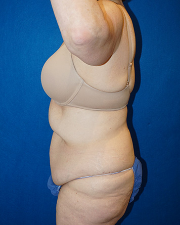 Tummy Tuck