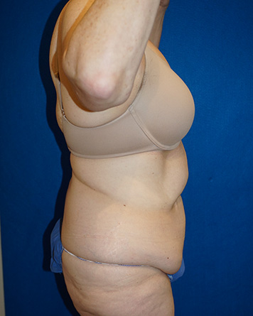 Tummy Tuck