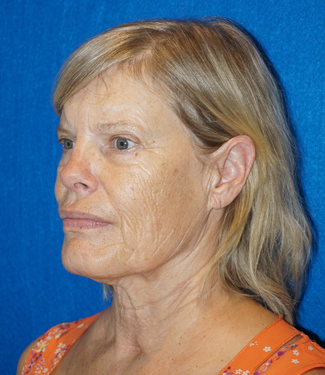 Facelift/Necklift