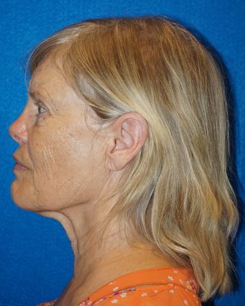 Facelift/Necklift