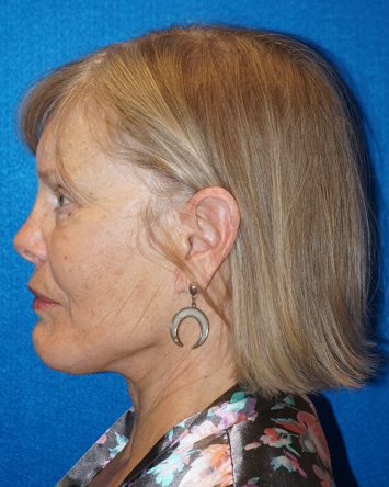 Facelift/Necklift