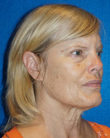 Facelift/Necklift