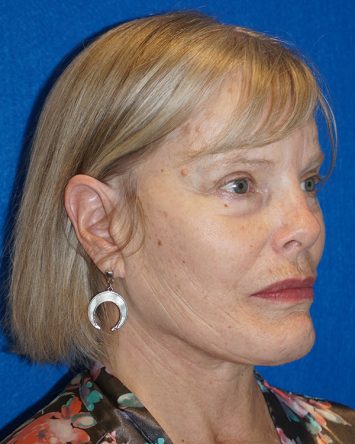 Facelift/Necklift