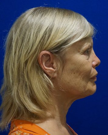 Facelift/Necklift