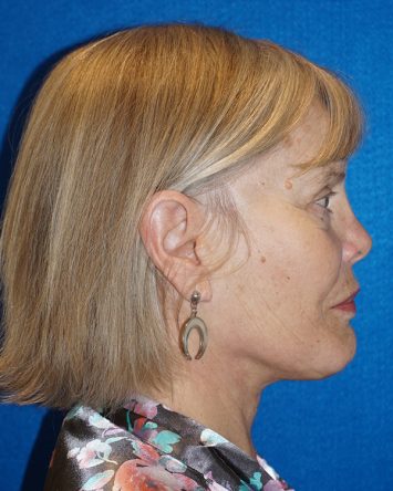 Facelift/Necklift