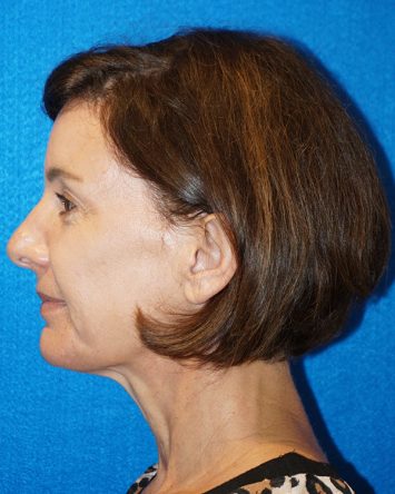 Facelift/Necklift