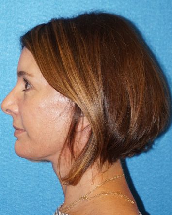 Facelift/Necklift