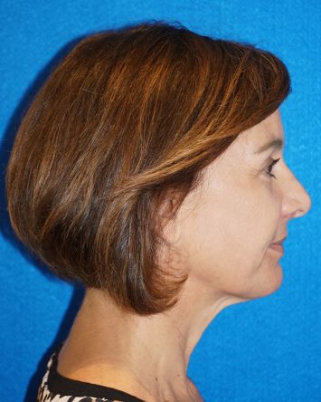 Facelift/Necklift