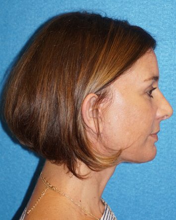 Facelift/Necklift