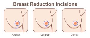 Breast Reduction Incisions Sacramento CA