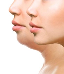 Kybella Double Chin Treatment Sacramento, CA