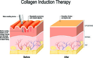 RF microneedling Sacramento 